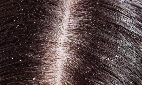 頭皮屑多如何去除小妙招 頭皮屑多如何去除小妙招
