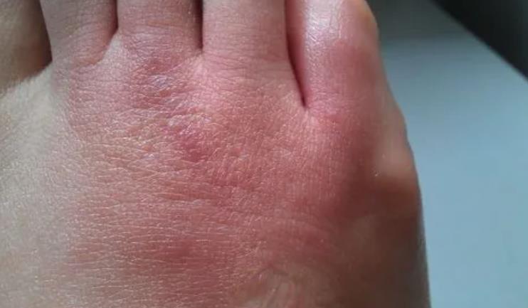 被螞蟻咬后又紅又腫又癢怎么辦 被螞蟻咬后又紅又腫又癢怎么辦