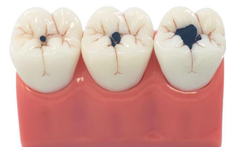 蛀牙如何讓它停止腐蝕 蛀牙如何讓它停止腐蝕