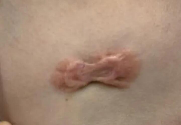 疤痕增生如何消除 疤痕增生如何消除