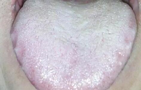 舌苔厚白是怎么回事 舌苔厚白是怎么回事