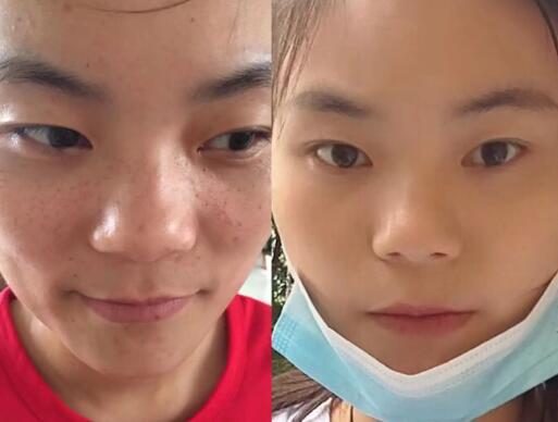 有什么方法祛斑 有什么方法祛斑