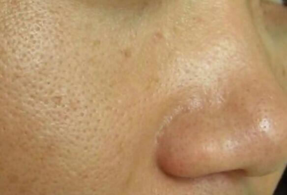 毛孔粗大怎么辦怎么收縮毛孔 毛孔粗大怎么辦怎么收縮毛孔