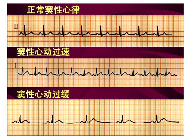 竇性心律是健康的嗎?